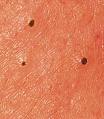 How to get rid of blackheads | Natural Remedies for Acne