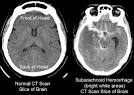 <b>Subarachnoid Hemorrhage</b> (SAH) - Stroke Center | UW Medicine, Seattle