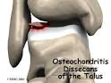 <b>Osteochondritis dissecans</b>