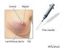 Female breast biopsy: MedlinePlus Medical Encyclopedia Image