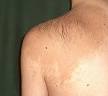 Becker's <b>nevus</b> on the left