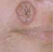 blastomycosis - definition of blastomycosis in the Medical ...