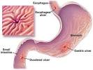 <b>stomach</b> tissue causing