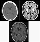 Acute <b>chorea</b> and bilateral