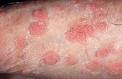 avere <b>condilomi acuminati</b>,