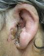 case of <b>otitis externa</b>.