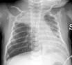 Pediatric Bronchiolitis