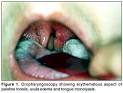 Revista Brasileira de Otorrinolaringologia - Agranulocytosis with ...