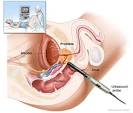 Prostate Biopsy | Weiss Memorial Hospital