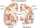 <b>Demenze</b>: la Malattia di