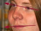 Fibrous Dysplasia - Oblique
