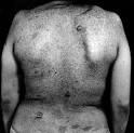 with neurofibromatosis and