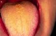 <b>Lengua</b> descamada o inflamación