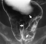 shows <b>rectal carcinoma</b>,