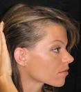 Telogen Effluvium, Diffuse Alopecia | WomenHG