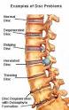 Lumbar Degenerative Disc Disease