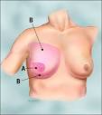 Image - Skin -Sparing Mastectomy
