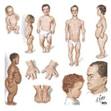 <b>Acondroplasia</b>::