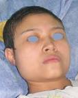 <b>Facies</b> cortisónica o