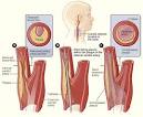 CardioSmart: Carotid Artery Disease