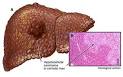 <b>Hepatocellular Carcinoma</b> in