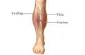 Shinbone Fracture   Bones Joints Info