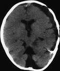 <b>Chronic subdural hematoma</b> in a