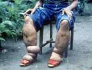 Kaki gajah karena <b>filariasis</b>.