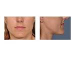 But in large chin reductions,