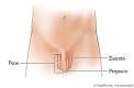 Un <b>espermatocele</b> es una