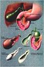 <b>Doenças</b> da <b>Vesícula Biliar</b>