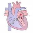Mitral regurgitation - Wikipedia, the free encyclopedia