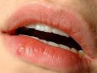 <b>Lip</b> Blisters