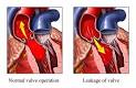 Aortic Regurgitation