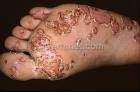 <b>Reiter Syndrome</b> Photo - Skin Disease Pictures