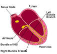 HeartPoint: Arrhythmias - Introduction