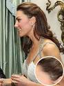 Duchess of Cambridge Scarred by Childhood Operation   People