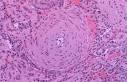 <b>arteriolosclerosis</b>