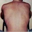 Dengue fever - Wikipedia, the free encyclopedia