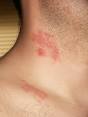 Herpes zoster - Wikipedia, the free encyclopedia