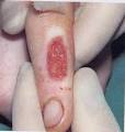 Chemcial Burn