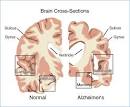 Short Memory Test devolped to Identify Alzheimer's/Mild Cognitive ...