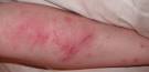 How to Get Rid of Poison Oak Rash &amp; Itch | eHow.