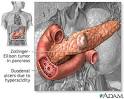 Peptic ulcers - Causes