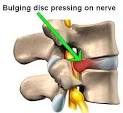 HERNIATED DISC | Blog | NJSR