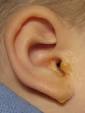 Otitis externa: Swimmer's ear, infection and inflammation of the ...