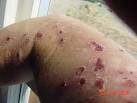 CIA and Morgellons Disease | Health