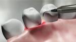 Marty Jablow DMD - Dental News and Technology : Laser Perio ... 