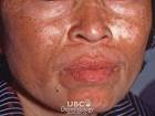 Melasma is not dangerous or