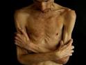 Medusa: MALE ANOREXIA: BRYAN BIXLER IS DYING [UPDATE: January 30 ...